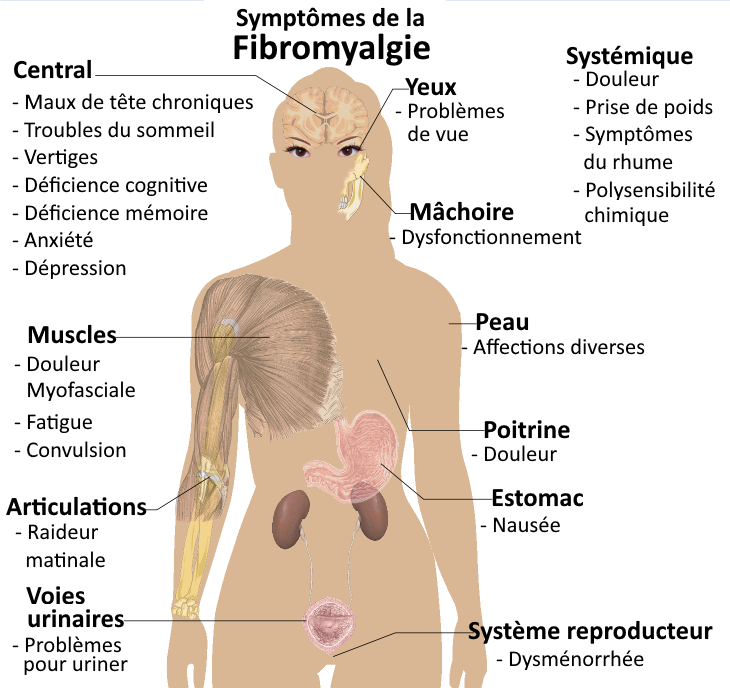 Symptômes et diagnostic de la fibromyalgie